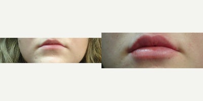 Volbella before and after photo