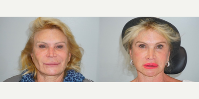 Facelift before and after photo
