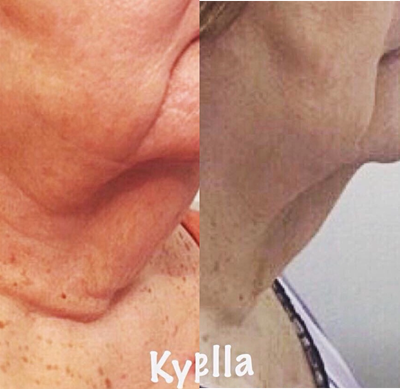 Kybella before and after photo