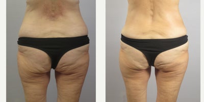 Liposuction before and after photo