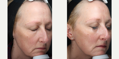 Nonsurgical Facelift before and after photo