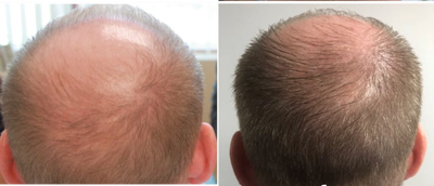 PRP for Hair Loss before and after photo