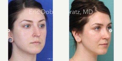 Septoplasty before and after photo