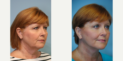 Facelift before and after photo