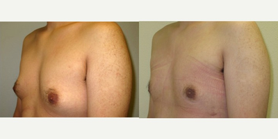 Gynecomastia Surgery before and after photo