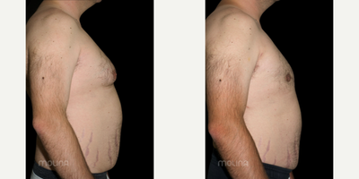 Gynecomastia Surgery before and after photo
