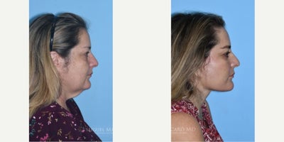 Neck Lift before and after photo