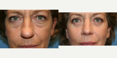 Rhinoplasty before and after photo