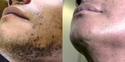 Electrolysis before and after photo