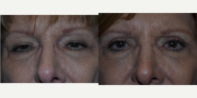 Eyelid Surgery before and after photo
