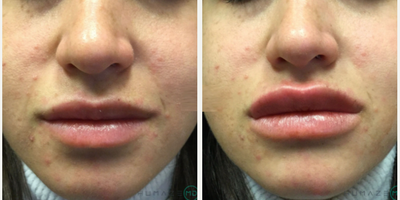 Juvederm before and after photo