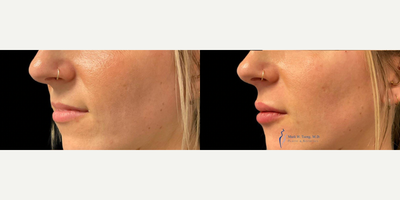 Lip Fillers before and after photo