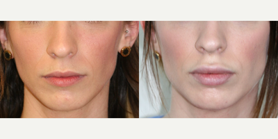Lip Fillers before and after photo