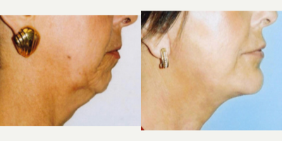 Neck Lift before and after photo