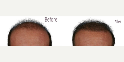 NeoGraft before and after photo