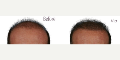 NeoGraft before and after photo