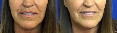 Restylane Refyne before and after photo