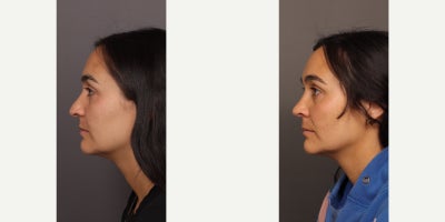 Rhinoplasty before and after photo