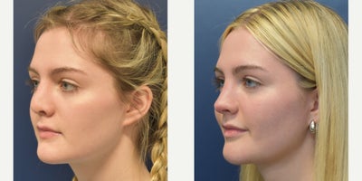 Septoplasty before and after photo