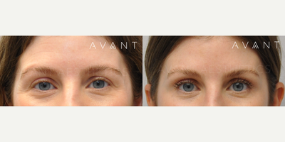 Botox before and after photo