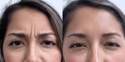 Botox before and after photo