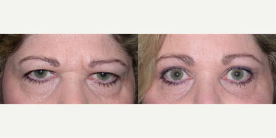 Brow Lift before and after photo