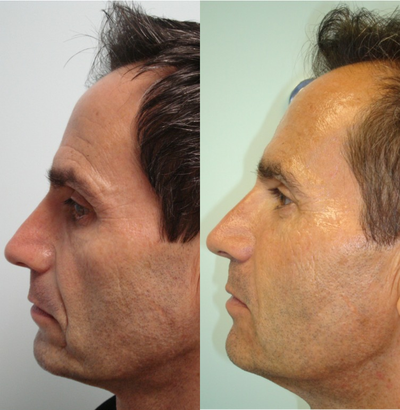 Liquid Facelift before and after photo