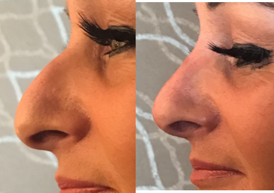 Nonsurgical Nose Job before and after photo