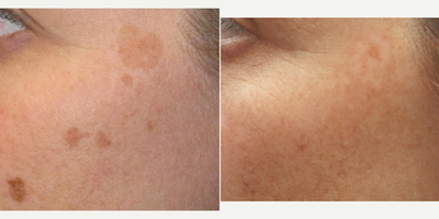 YAG Laser before and after photo