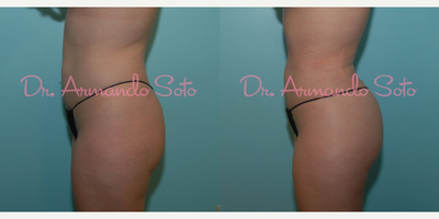 Brazilian Butt Lift before and after photo