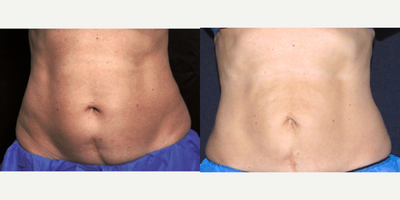 CoolSculpting before and after photo