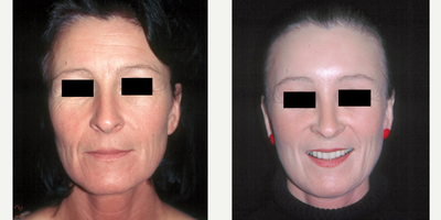 Facelift before and after photo