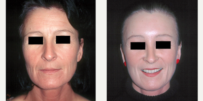 Facelift before and after photo