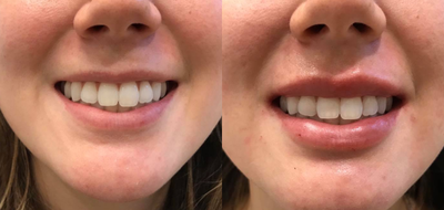 Juvederm before and after photo