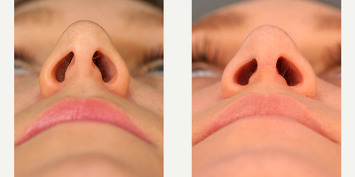 Rhinoplasty before and after photo