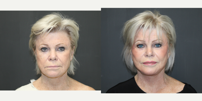 Facial Fat Transfer before and after photo