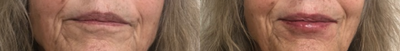 Juvederm before and after photo