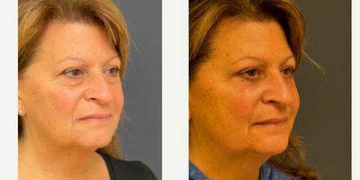 Eyelid Surgery before and after photo