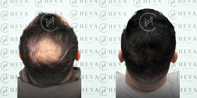 FUE Hair Transplant before and after photo