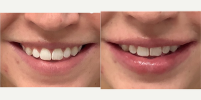 Lip Fillers before and after photo