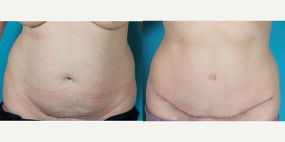Tummy Tuck before and after photo