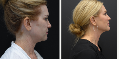 FaceTite before and after photo
