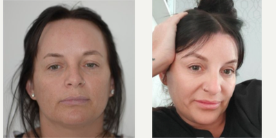 Forehead Reduction before and after photo