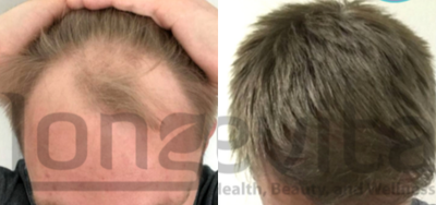 Hair Loss Treatment before and after photo