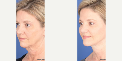 Neck Lift before and after photo