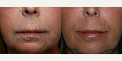 Restylane Silk before and after photo