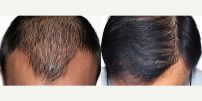 ARTAS Robotic Hair Transplant before and after photo