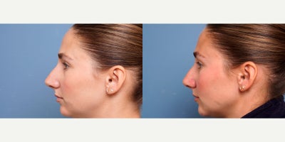 Cheek Fillers before and after photo
