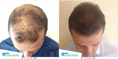 FUE Hair Transplant before and after photo