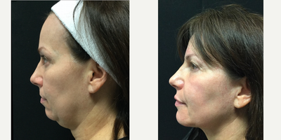 Laser Liposuction before and after photo